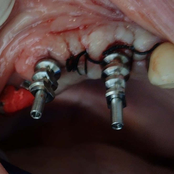Chirurgia Implantare e Impianti Denti fisse
